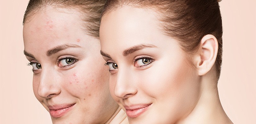 Acne Treatment with Laser