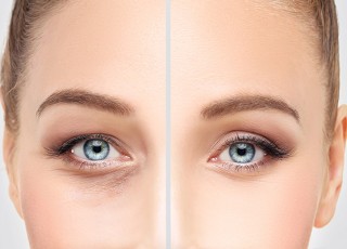 Eyelid Aesthetics