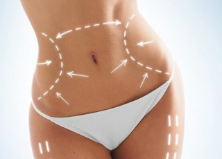 Laser Lipolysis