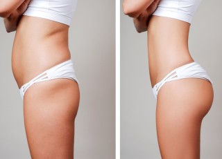 Butt Aesthetics, Butt (Hip) Enlargement