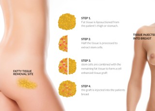 Fat Injection